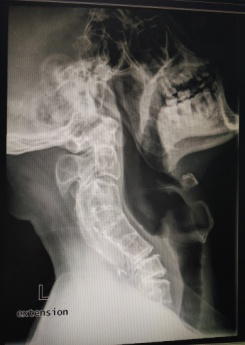 脊柱外科完成1例高难度颈椎手术
