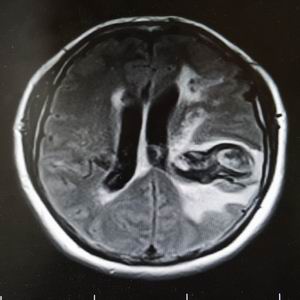 我院神经外科治疗罕见蛇形动脉瘤1例